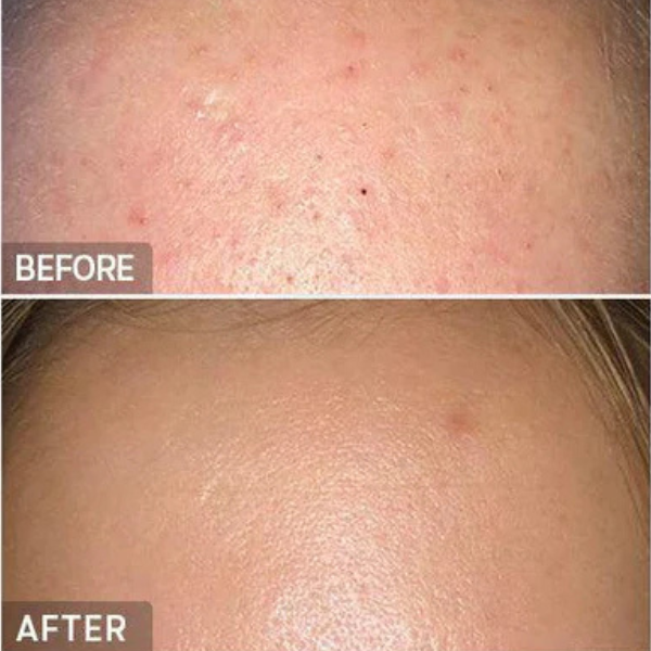 BHA Blackhead Power Liquid Cosrx 
