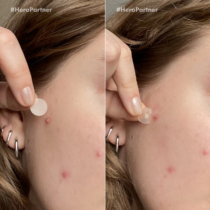 מארז מדבקות 'מייטי פאצ' לטיפול בפצעונים דקות במיוחד לשימוש ביום ובלילה 12 יח' - Hero